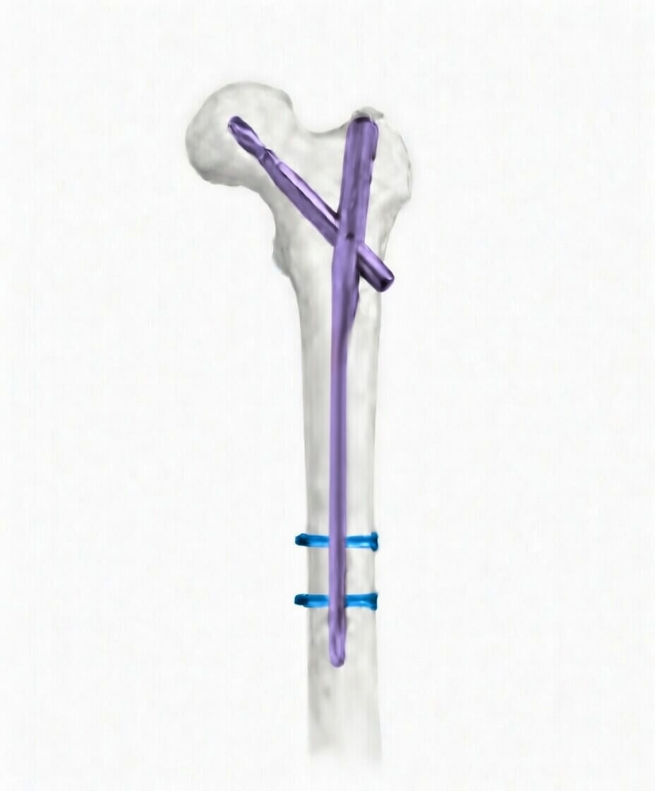 Проксимальний стегновий стрижень, антиротаційний, лівий (PFNA) (Jinlu)